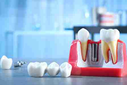 a teeth dental implant