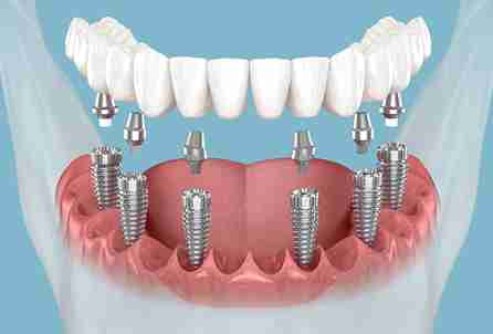 implant process