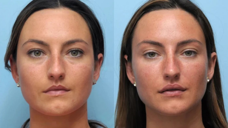 Thread lift Treatments in Dubai