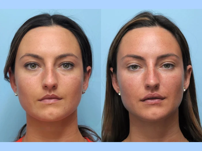 Best Doctors in Dubai for Thread Lift: Enhance Your Facial Contours